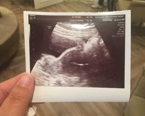 圣洁莓对多囊卵巢有什么作用