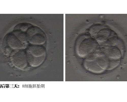 北京做试管代孕费用 提高北京大学第三医院做试管婴儿成功率的方法 ‘孕囊形